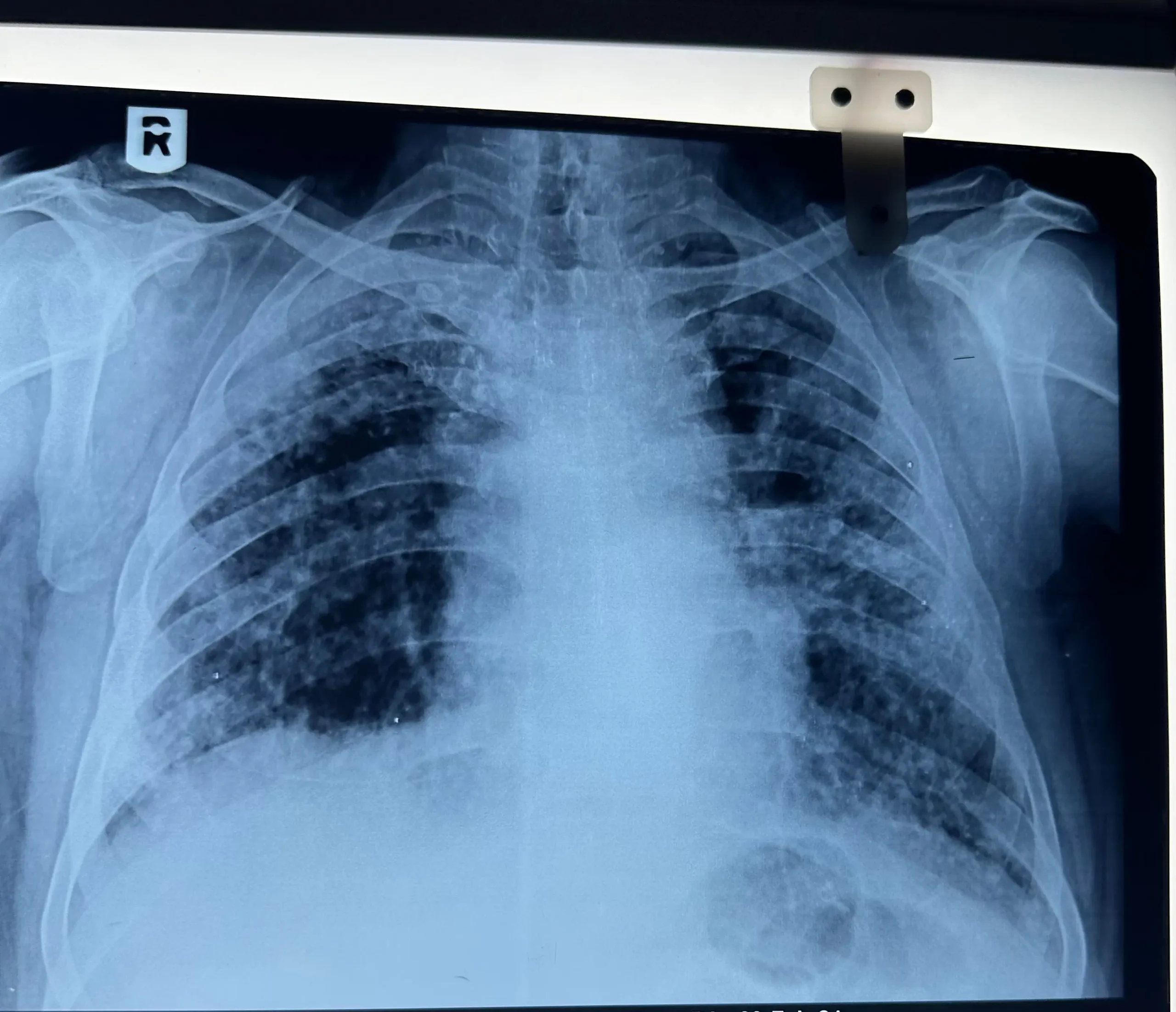silicosis damage xray
